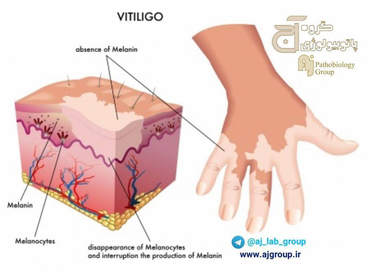 ویتیلیگو (Vitiligo) چيست؟